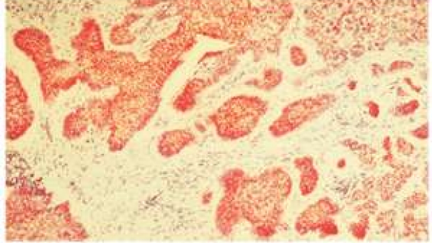 Basal cell carcinomas
